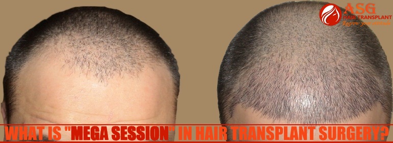 hair-transplant-in-punjab